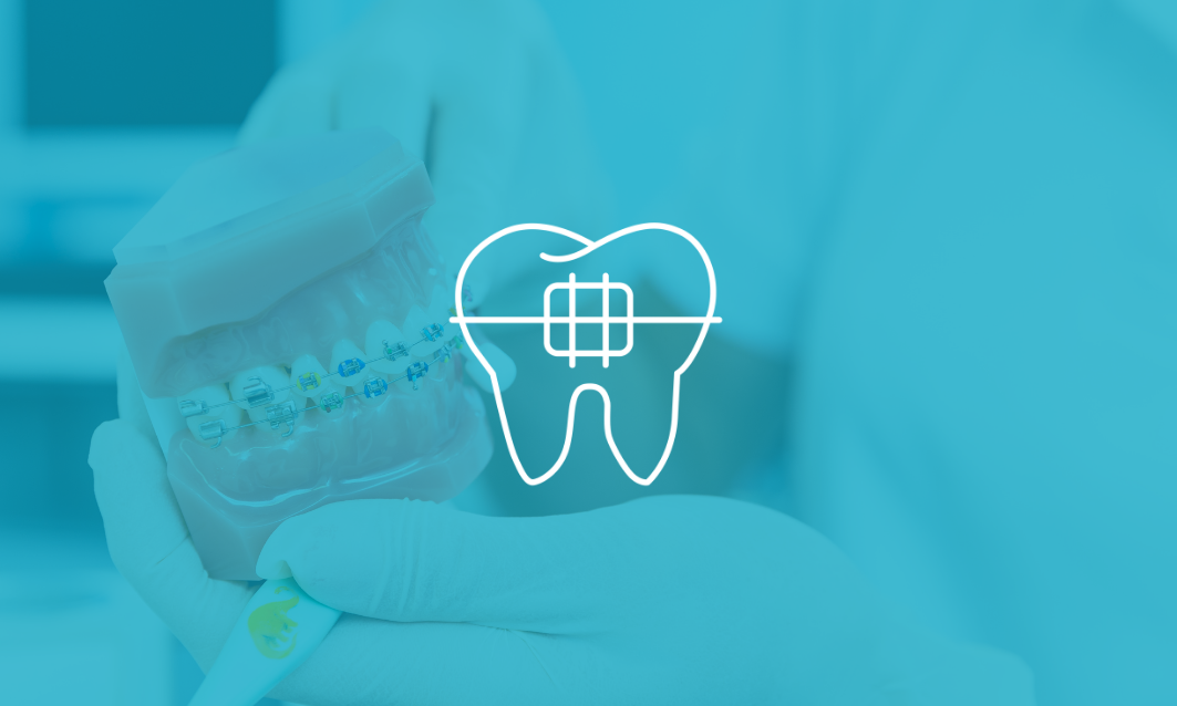 Apparecchio fisso con brackets per ortodonzia